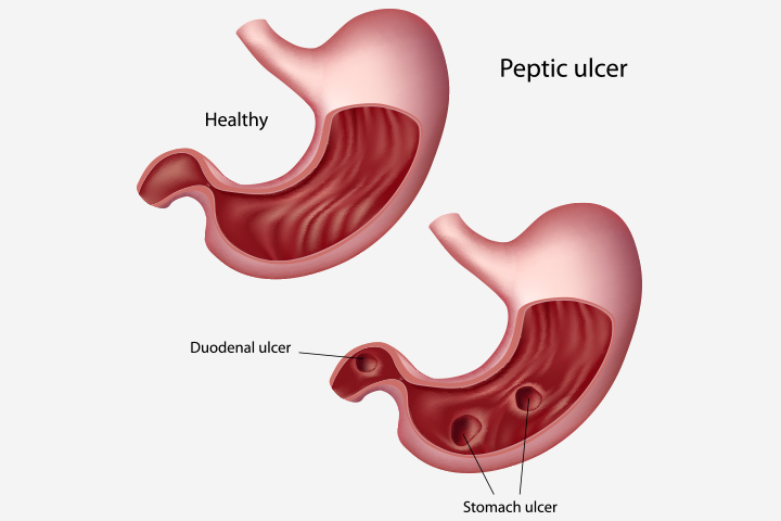 A-Peptic-Ulcer-During-Pregnancy1